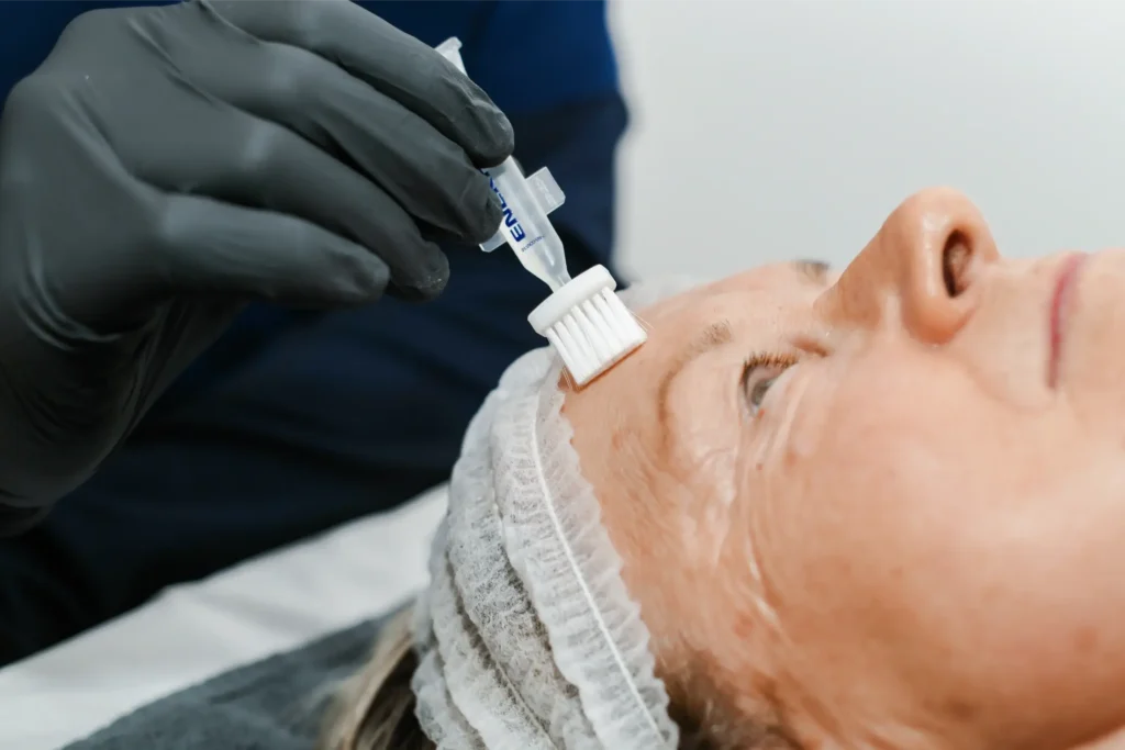 A chemical peel treatment on a client's forehead