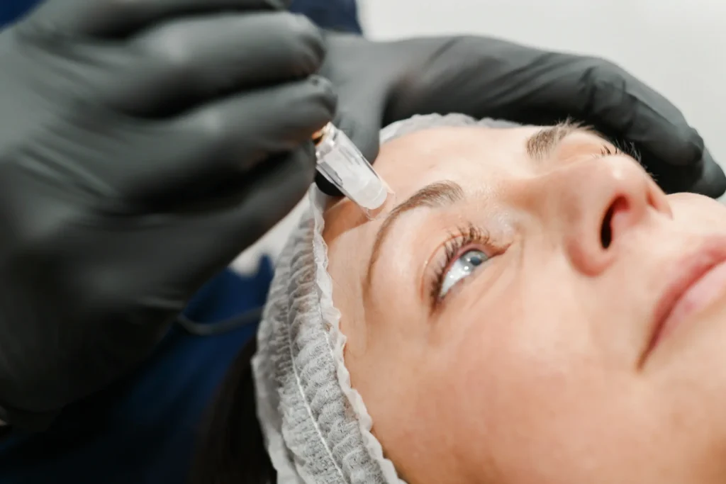 Microneedling treatment on a woman's forehead